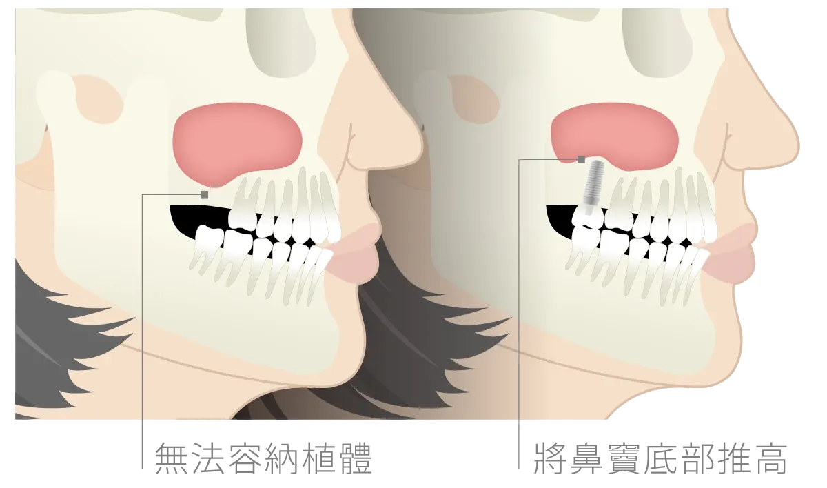 台中南投生活牙醫生活牙醫上顎後牙植牙鼻竇增高術示意